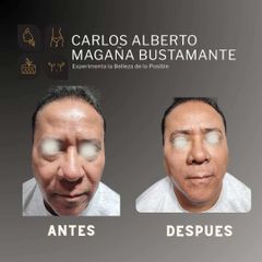 Armonización facial full face - Dr. Carlos Alberto Magaña Bustamante