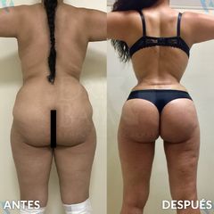 Mommy Makeover - Hispali
