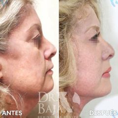 Lifting Facial - Hispali