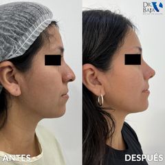 Rinoplastia - Hispali