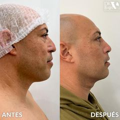 Papada y Perfilamiento Facial - Hispali