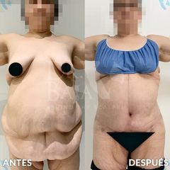 Lipectomia en T - Hispali