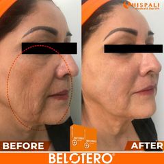 Relleno Facial - Hispali