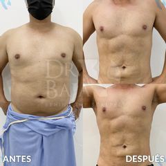 Lipoescultura HD con Marcación Abdominal - Hispali