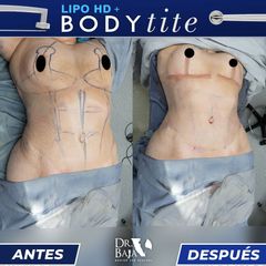 Lipoescultura HD + BodyTite - Hispali