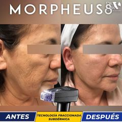 Lifting Facial + Morpheus8 - Hispali