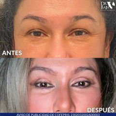 Blefaroplastia - Dr. Renato Rodríguez Hirales