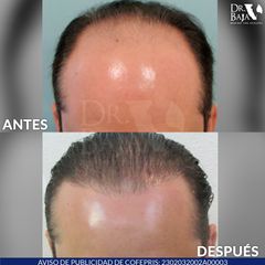 Trasplante de Cabello - Dr. Renato Rodríguez Hirales