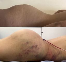 Antes y después de  Aumento glúteos 