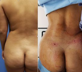Antes y después de Lipo espalda 