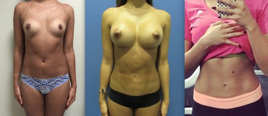 Antes y después de lipo con implante Dr. Iván Torres Baltazar