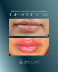 Aumento de labios - Dr. Farid Vera