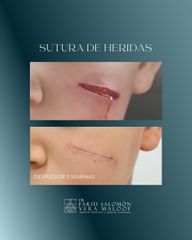 Eliminación de cicatrices - Dr. Farid Vera