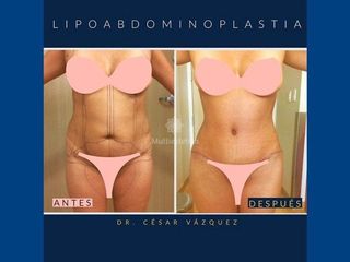 Antes y después de Lipoabdomindoplastia