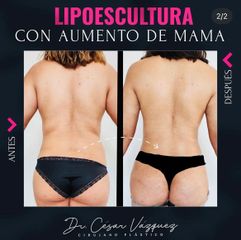 Lipoescultura - Dr. César Vázquez