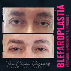 Blefaroplastia - Dr. César Vázquez
