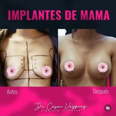 Aumento mamario - Dr. César Vázquez