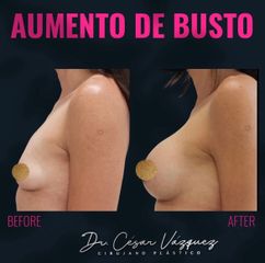 Aumento de busto - Dr. César Vázquez