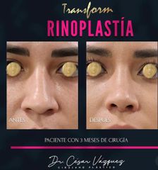 Rinoplastia - Dr. César Vázquez
