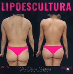 Lipoescultura - Dr. César Vázquez