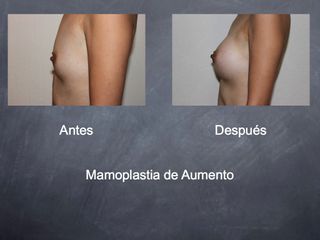 Antes y después de Aumento de Busto