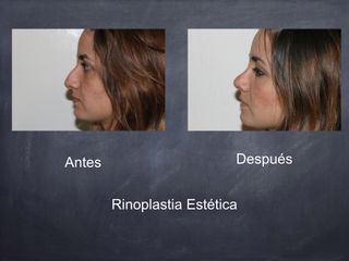 Antes y después de Rinoplastía