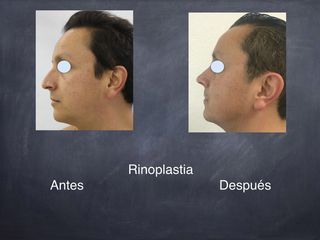 Antes y después de Rinoplastia