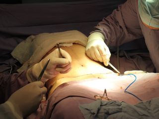 Abdominoplastia (Tummy Tuck)