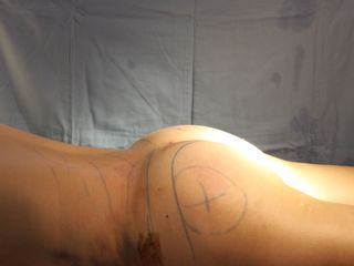 Gluteoplastia (Lipotransferencia de grasa)