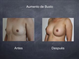 Antes y después de Aumento de Busto