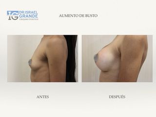 Antes y después de Aumento de busto 