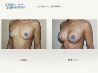 Antes y después de Aumento de busto