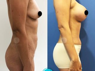 Antes y después de Lipoabdominoplastia