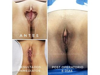 Rejuvenecimiento Vaginal antes y después - 641818