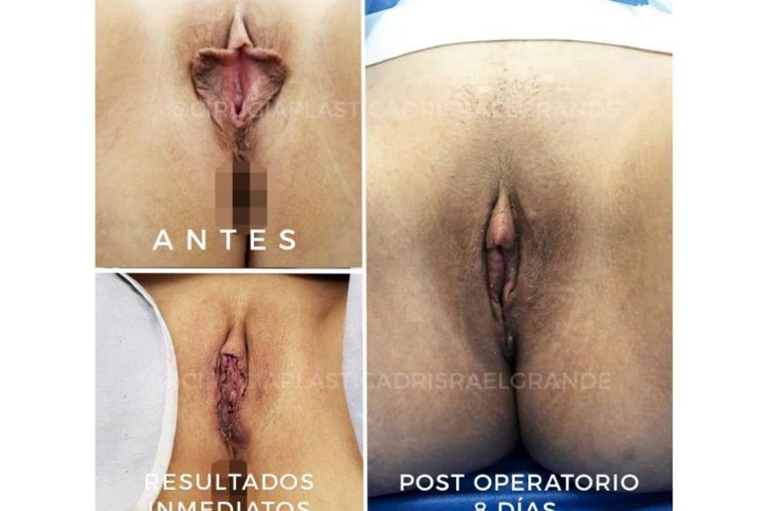 Rejuvenecimiento Vaginal antes y después - 641818