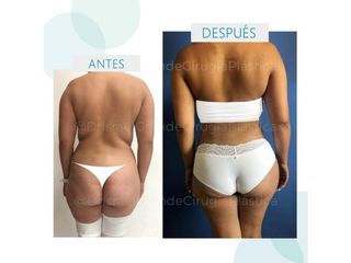 Antes y después de Liposucción