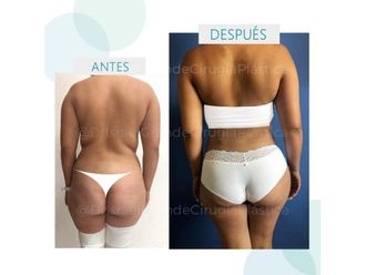 Clinicas De Liposuccion En Tuxtla Gutierrez Multiestetica Mx