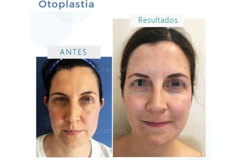 Otoplastia antes y después - 641824