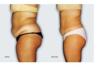 Antes y después de tratamientos anticelulíticos. Elimina celulitis, Reduce Talla, Moldea Figura