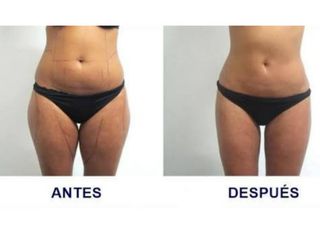 Antes y después de Cavitaciòn