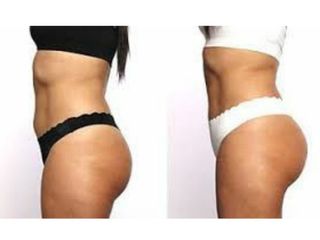 Antes y después de tratamientos anticelulíticos. Electroestimulaciòn muscular