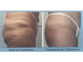 Antes y después de tratamientos anticelulíticos