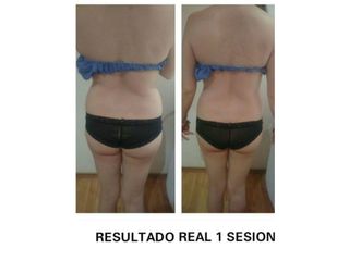 Antes y después de radiofrecuencia