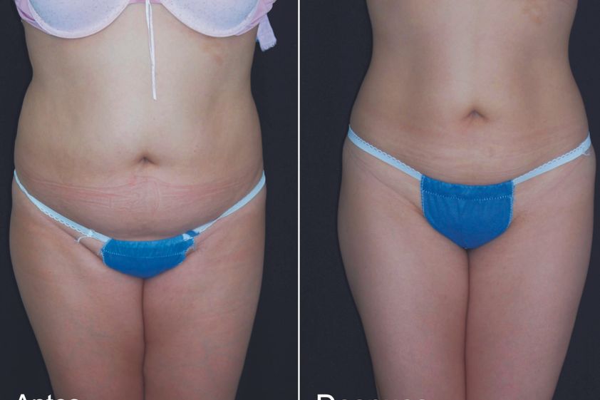 Mesoterapia antes y después - 324678