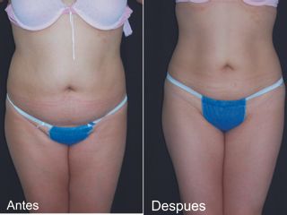 Antes y después de Mesoterapia + ultracavitación + radiofrecuencia. 