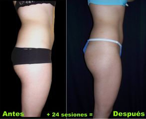 Antes y depués de lipoescultura 