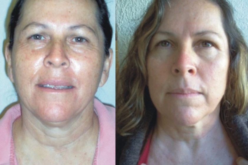 Plasma Rico en Plaquetas antes y después - 493854