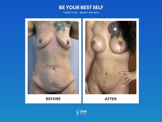 Antes y después Aumento de busto y abdominoplastia