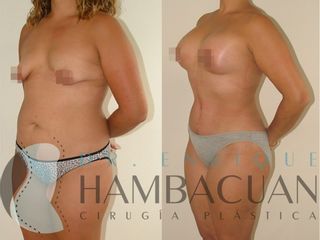 Antes y después de Mommy Makeover
