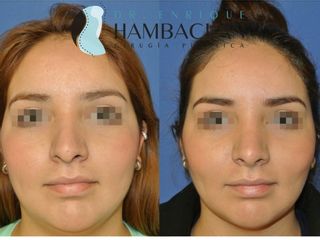 Antes y después de Bichectomia y liposucción de cuello